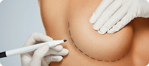 Breast Augmentation Surgery in Miami, FL