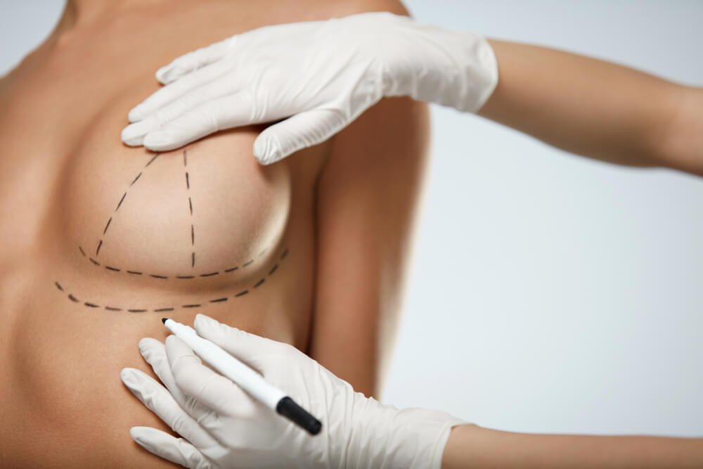 Female Body With Black Marks on Breasts Before Plastic Surgery Operation.