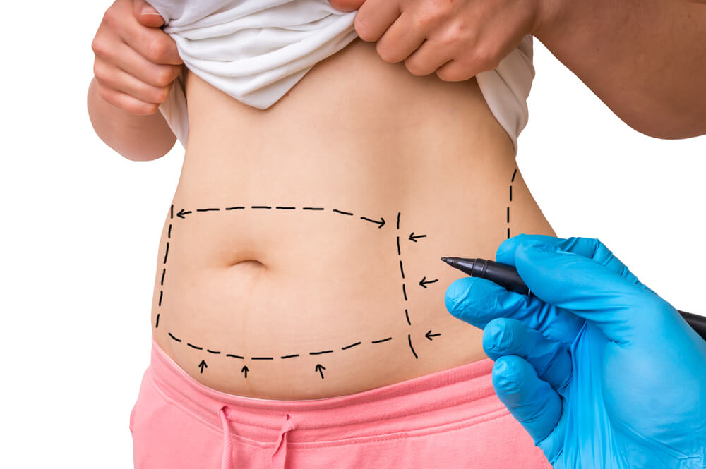 Plastic Surgery Doctor Draw Lines With Marker on Patient Belly 